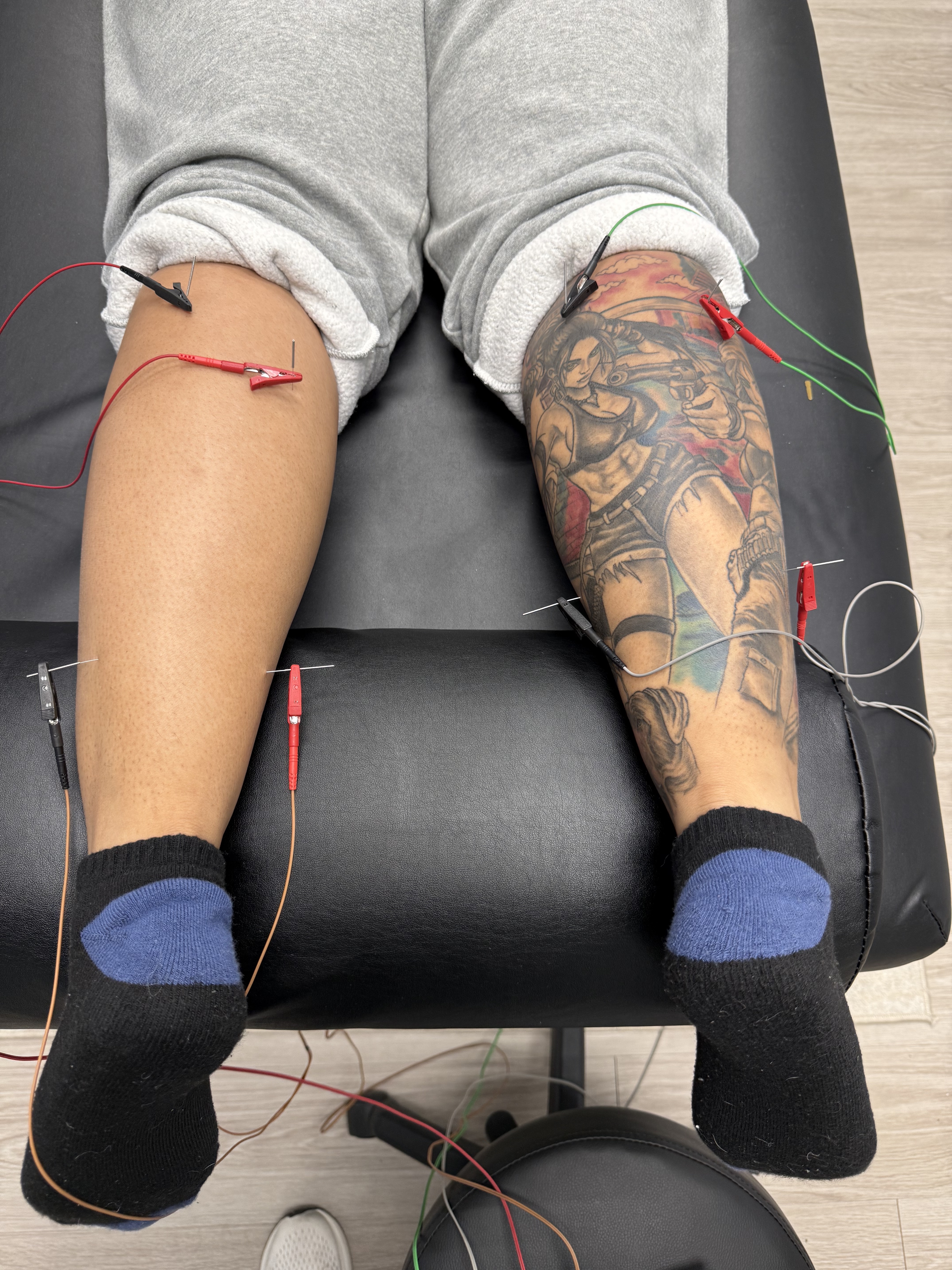 Dry Needling